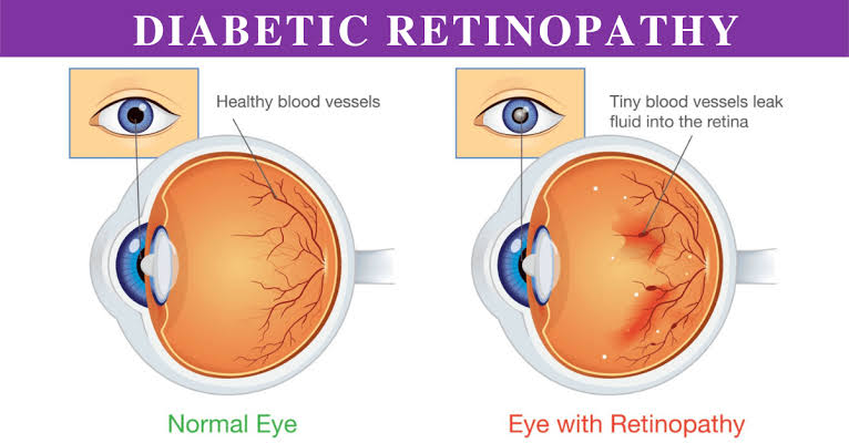 DIABETIC RETINOPATHY [DR]