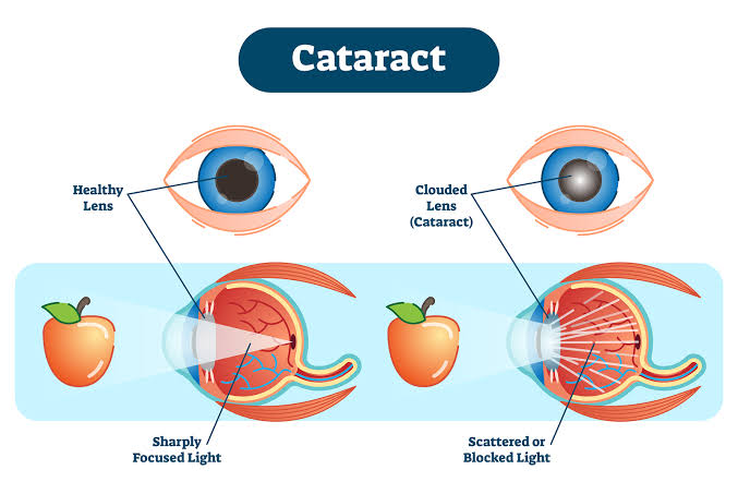 Nutritional management of Cataracts