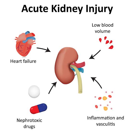 ACUTE KIDNEY INJURY