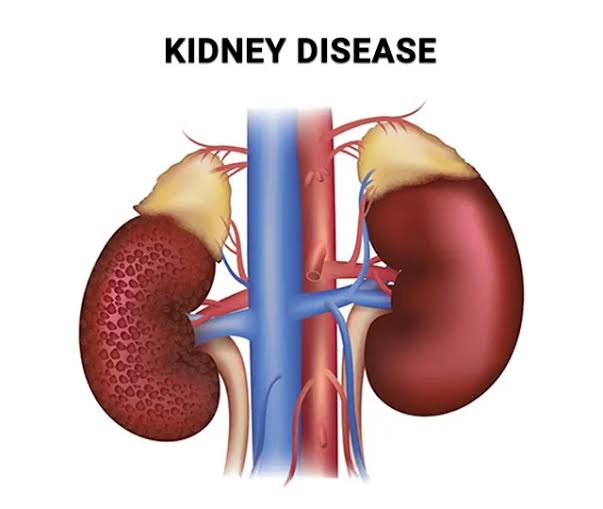 KIDNEY DISEASE