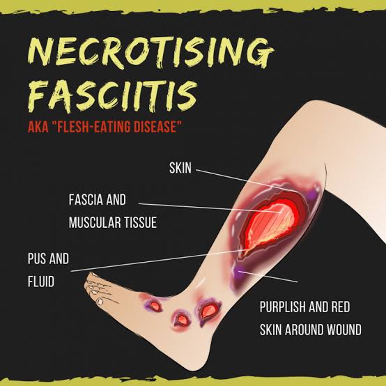 Necrotizing Fasciitis And Nutritional Management