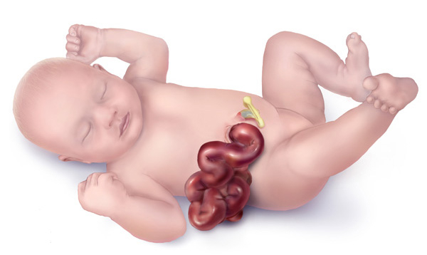 GASTROCHISIS AND NUTRITIONAL MANAGEMENT I